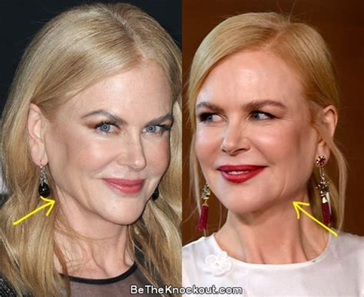 Did Nicole Kidman Have Facelift & Lip Augmentation?